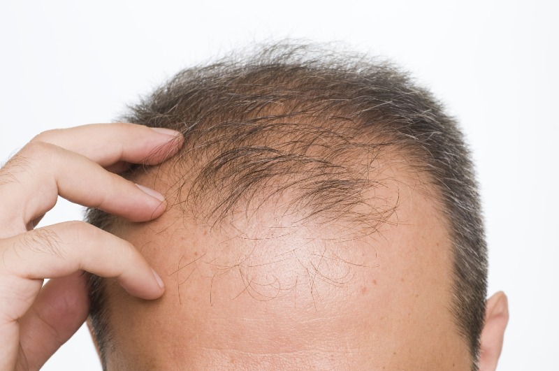 Quelques conseils pour prévenir une chute de cheveux abondante ?